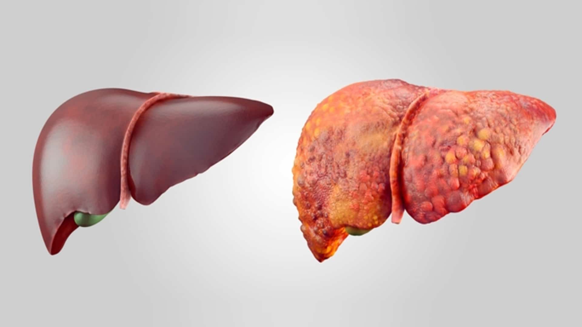 Hígado graso y sus causas. - Centro Médico Monjitas